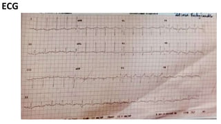ECG
 