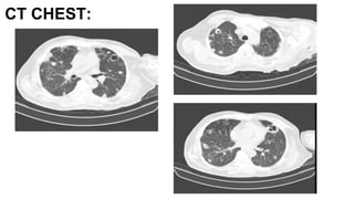 CT CHEST:
 