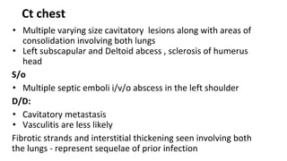 Ct chest
• Multiple varying size cavitatory lesions along with areas of
consolidation involving both lungs
• Left subscapular and Deltoid abcess , sclerosis of humerus
head
S/o
• Multiple septic emboli i/v/o abscess in the left shoulder
D/D:
• Cavitatory metastasis
• Vasculitis are less likely
Fibrotic strands and interstitial thickening seen involving both
the lungs - represent sequelae of prior infection
 