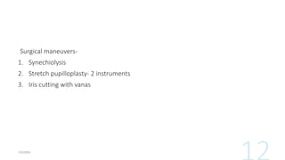 Surgical maneuvers-
1. Synechiolysis
2. Stretch pupilloplasty- 2 instruments
3. Iris cutting with vanas
 