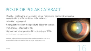 POSTRIOR POLAR CATARACT
Another challenging presentation with a heightened risk for intraoperative
complications is the posterior polar cataract.
Why PPC important?
•Strong adherence of the opacity to posterior capsule.
•26% chances of defective PC.
•High rate of intraoperative PC rupture (upto 36%).
Osher RH et al. J Cataract Refract Surg. 1990;16(2):157-162.
Vasavada AR, Singh R. Phacoemulsification in posterior polar developmental cataracts. In: Lu LW, Fine IH,
Phacoemulsification in Difficult and Challenging Cases. New York, NY: Thieme: 1999: 121-128.
 