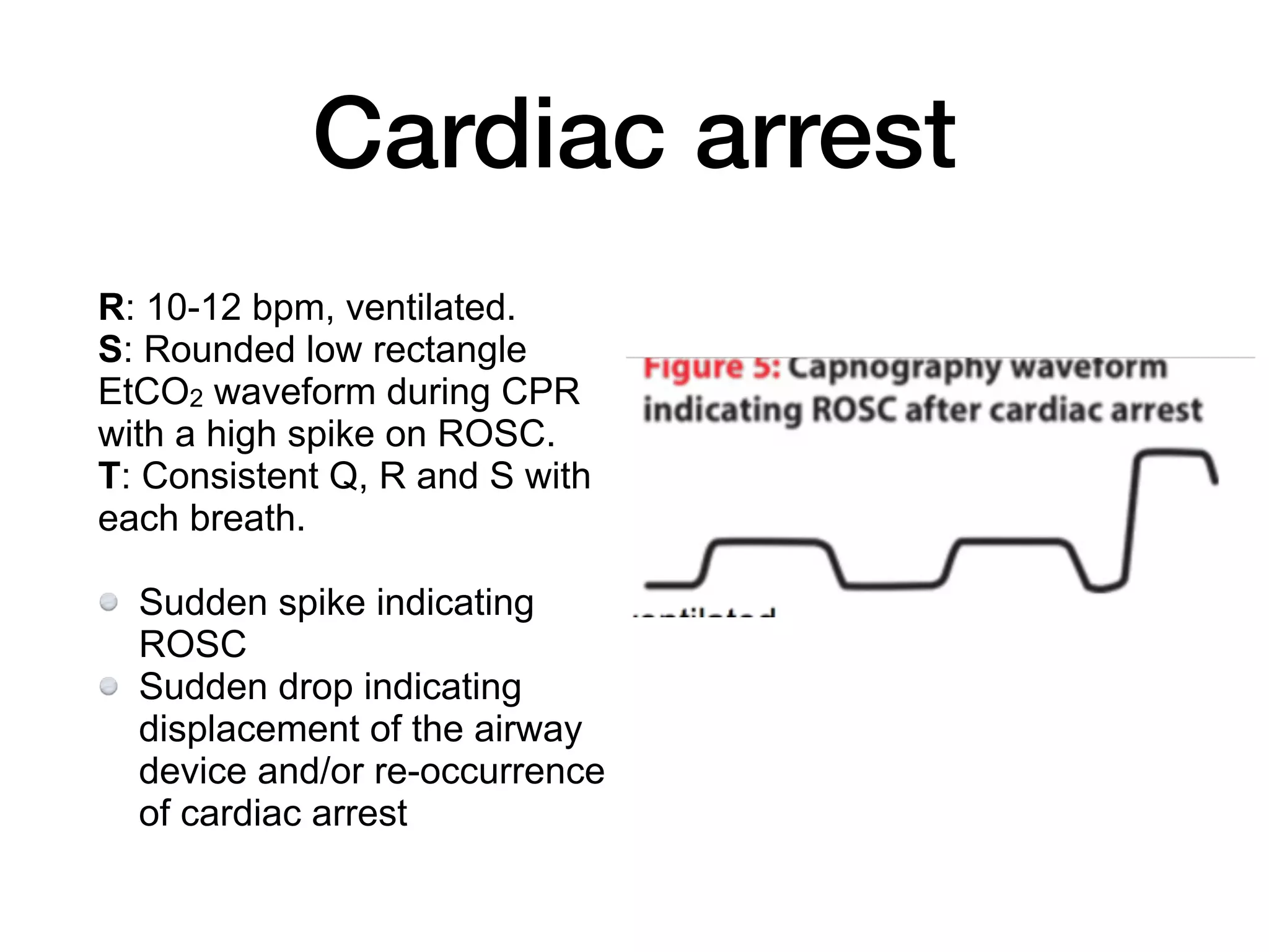 Capnography in emergency room | PDF