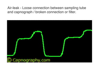 Capnography in emergency room | PDF