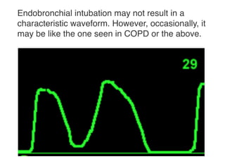 Capnography in emergency room | PDF