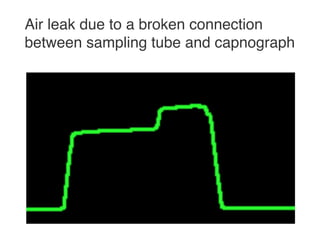 Capnography in emergency room | PDF