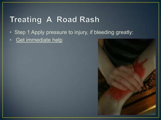Moderate Road Rash First Aid Presentation: Minor Burn and Moderate Road Rash | PPTX