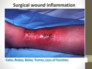 Calor, Rubor, Dolor, Tumor, Loss of function.
Surgical wound inflammation
19
 