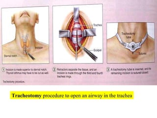 Tracheotomy  procedure to open an airway in the trachea 
