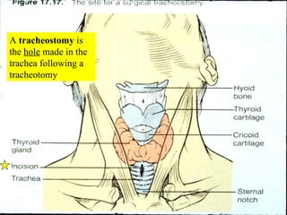A  tracheostomy  is the  hole  made in the trachea following a tracheotomy 