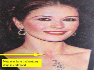 Note scar from tracheotomy done in childhood 