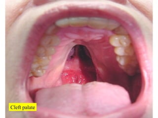 Cleft palate 