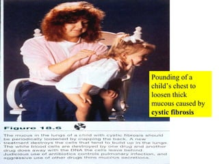 Pounding of a child’s chest to loosen thick mucous caused by  cystic fibrosis 