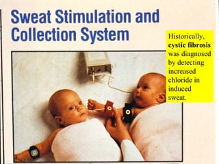 Historically,  cystic fibrosis  was diagnosed by detecting increased chloride in induced sweat. 