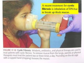 A recent treatment for  cystic fibrosis  is inhalation of DNAse to break up thick mucus. 