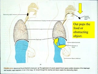 Out pops the food or obstructing object. 