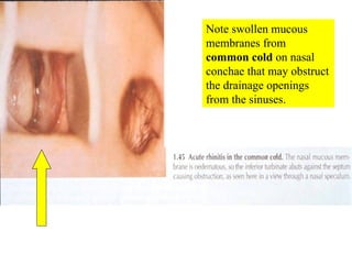 Note swollen mucous membranes from  common cold  on nasal conchae that may obstruct the drainage openings from the sinuses. 