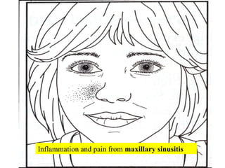 Inflammation and pain from  maxillary sinusitis 