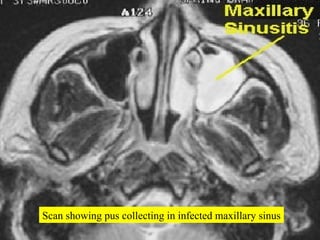 Scan showing pus collecting in infected maxillary sinus 