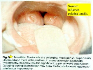 Swollen inflamed palatine tonsils. 