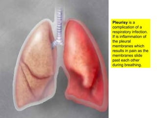 Pleurisy  is a complication of a respiratory infection.  If is inflammation of the pleural membranes which results in pain as the membranes slide past each other during breathing. 