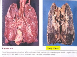 Lung cancer 