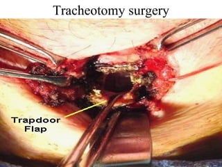 Tracheotomy surgery 