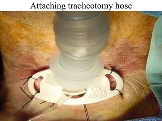 Attaching tracheotomy hose 