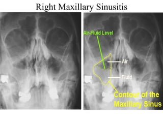 Right Maxillary Sinusitis 