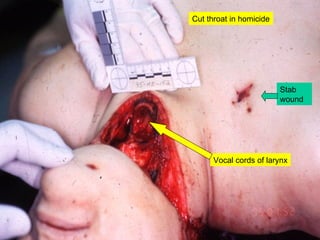 Vocal cords of larynx Cut throat in homicide Stab wound 