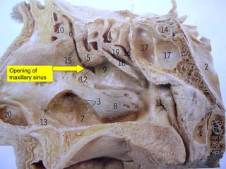 Opening of maxillary sinus 