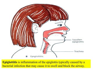 Epiglottitis  is inflammation of the epiglottis typically caused by a bacterial infection that may cause it to swell and block the airway. 