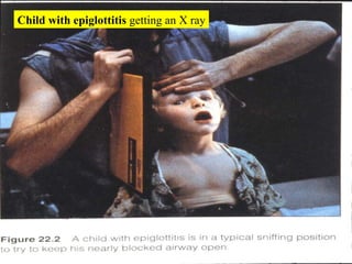 Child with epiglottitis  getting an X ray 