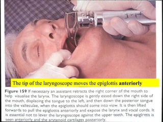 The tip of the laryngoscope moves the epiglottis  anteriorly 