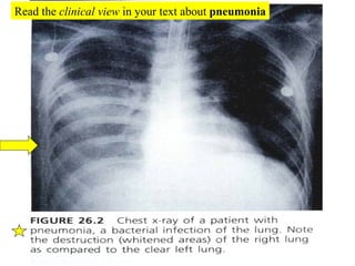 Read the  clinical view  in your text about  pneumonia 