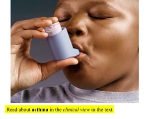 Read about  asthma  in the  clinical view  in the text 