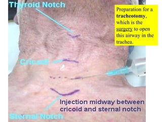 Preparation for a  tracheotomy , which is the  surgery  to open this airway in the trachea. 