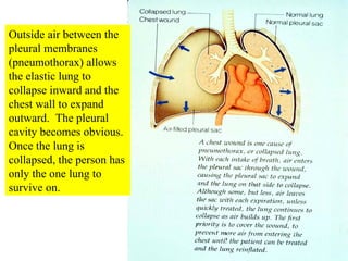 Outside air between the pleural membranes  (pneumothorax) allows the elastic lung to collapse inward and the chest wall to expand outward.  The pleural cavity becomes obvious.  Once the lung is collapsed, the person has only the one lung to survive on. 