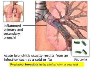 Read about  bronchitis  in the  clinical view  in your text 