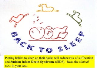 Putting babies to sleep  on their backs  will reduce risk of suffocation and  Sudden Infant Death Syndrome  (SIDS).  Read the  clinical view  in your text. 