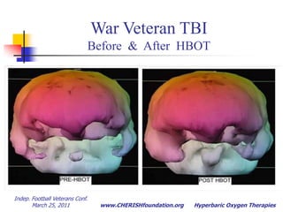 Indep. Football Veterans Conf.  March 25, 2011Hyperbaric Oxygen TherapiesDepthApplication0 fsw; 1 ATA16.5 fsw; 1.5 ATA33 fsw; 2 ATA49.5 fsw; 2.5 ATA59.4 fsw; 2.8 ATA66 fsw; 3 ATA165 fsw; 6 ATASea levelChronic Brain InjuryBurnsDiabetic Wounds/OsteoCO PoisoningAcute Cyanide PoisoningAcute Decompression Illness