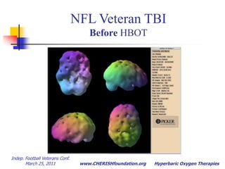 How it works - 5,769+* ways*          Oxygen-sensitive outcomes and gene expression in acute ischemic stroke. Rink C, Roy S, Khan M, Ananth P, Kuppusamy P, Sen CK, Khanna S. J Cereb Blood Flow Metab. 2010 Feb 10. Up-regulates growth factorsReduces edemaIncreases neuronal ATPEnhances Mitochondrial: ReplicationEnergy Production (ATP)Promotes neural pathway growthStimlates aging neuronsDown-regulates inflammationReduces reperfusion injuryIndep. Football Veterans Conf.  March 25, 2011