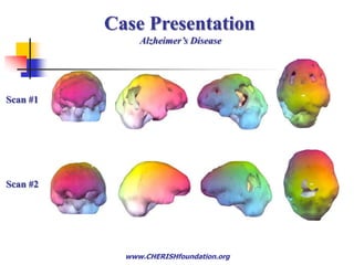 Indep. Football Veterans Conf.  March 25, 2011Hyperbaric Oxygen TherapiesHBOT Is Very Safe 	From a 10 year study of 1,505 patients receiving 52,758 2-hour HBOT sessions at 2.4 ATA once or twice daily.     inability to equalize middle ear pressure    0.37%     paranasal sinus blocks                             0.09%     confinement anxiety                                0.05%     oxygen convulsions                                 0.009%     pulmonary oxygen toxicity                        0.00%      permanent ocular refractive changes         0.00% 