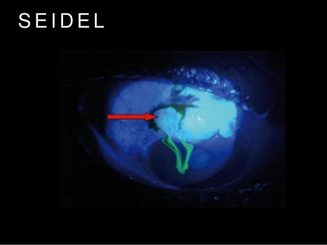 emergency ophthalmology orbital light glasses