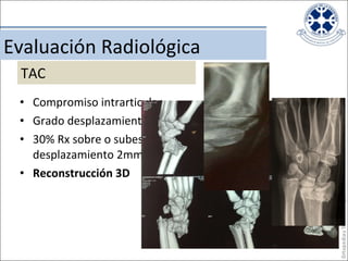 Compromiso intrarticular Grado desplazamiento 30% Rx sobre o subestiman desplazamiento 2mm (Cole,1997) Reconstrucción 3D Evaluación Radiológica TAC 