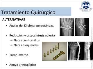 Agujas de  Kirshner percutáneas. Reducción y osteosíntesis abierta Placas con tornillos Placas Bloqueadas Tutor Externo Apoyo artroscópico Tratamiento Quirúrgico ALTERNATIVAS 