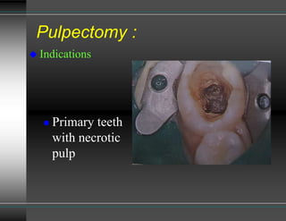 Pulpuctomy pulpectomy in primary dentition is very important skill.in this seminar ...