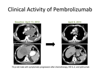Clinical Activity of Pembrolizumab
Baseline: April 13, 2012
72-yr-old male with symptomatic progression after chemotherapy, HD IL-2, and ipilimumab
April 9, 2013
UCLA Health. Reproduced with permission.
 