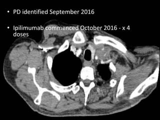 • PD identified September 2016
• Ipilimumab commenced October 2016 - x 4
doses
 
