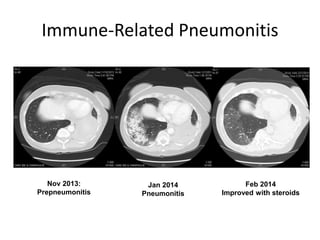 Immune-Related Pneumonitis
Nov 2013:
Prepneumonitis
Jan 2014
Pneumonitis
Feb 2014
Improved with steroids
 