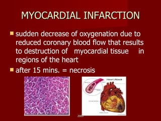 MYOCARDIAL INFARCTION sudden decrease of oxygenation due to reduced coronary blood flow that results to destruction of  myocardial tissue  in regions of the heart after 15 mins. = necrosis 2009 